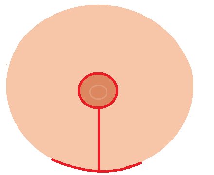 Scars after Breast Reduction