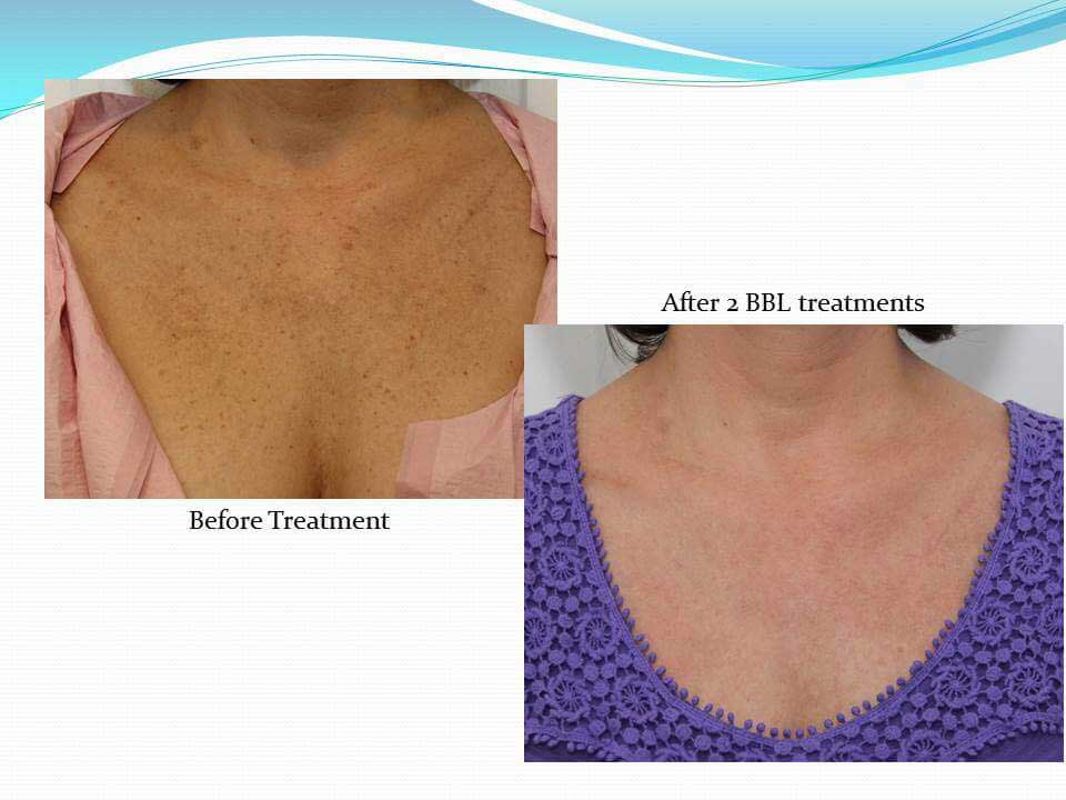 BBL treatment of the chest