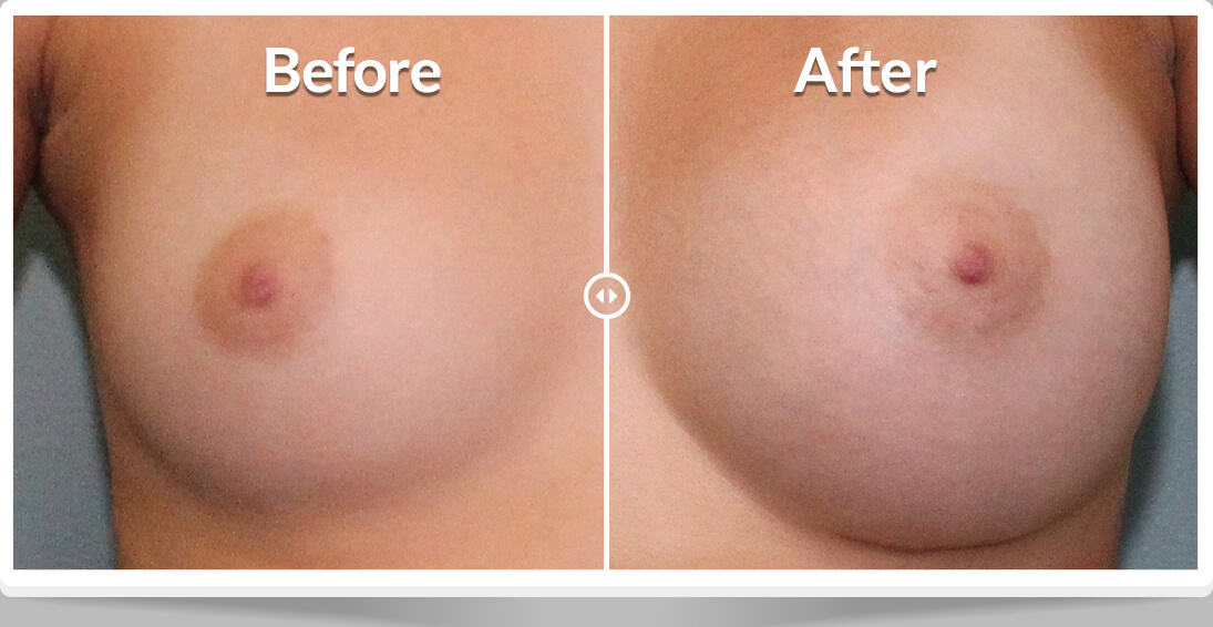 Breast Augmentations in Mentor, OH