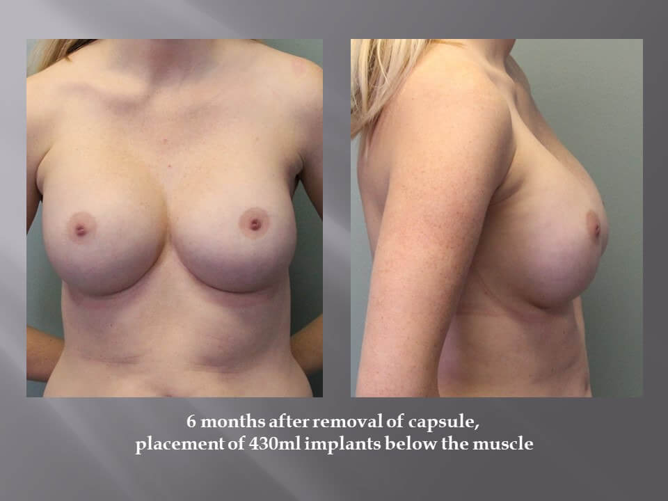 Ohio Breast Implant Removal