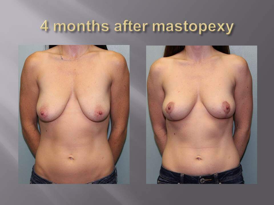 Greer Plastic Surgery Mastopexy