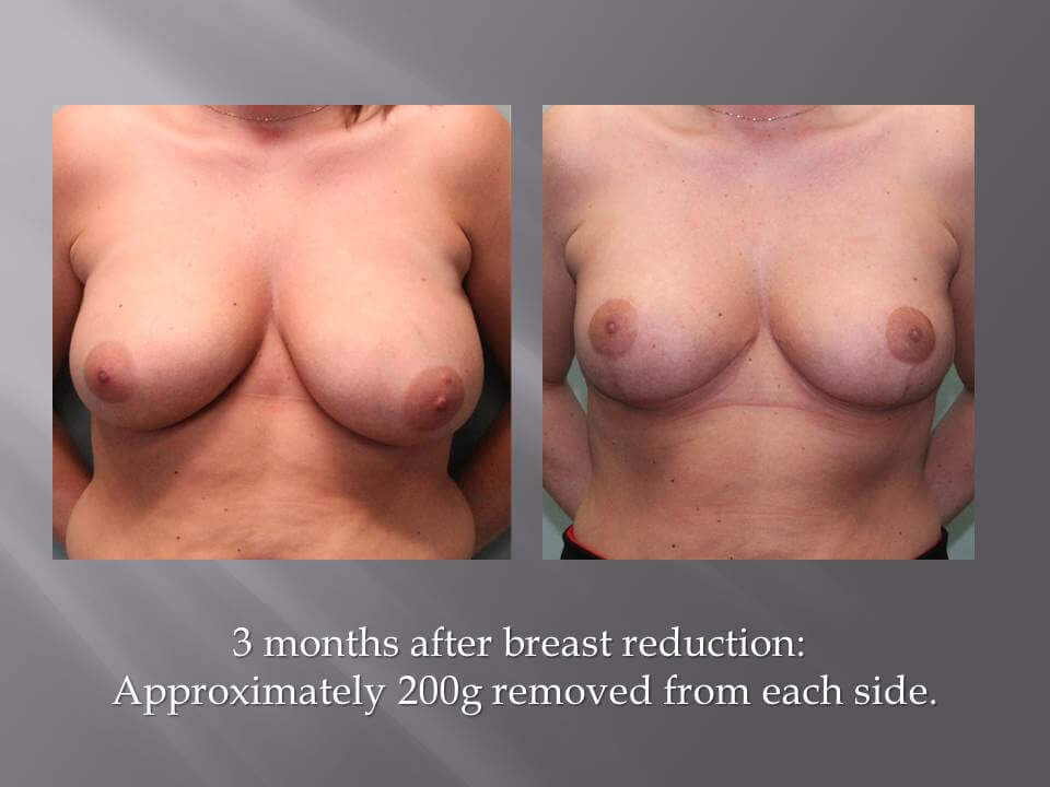 Breast Reduction in Ohio