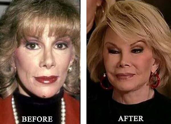 Will a face lift make me look unnatural?