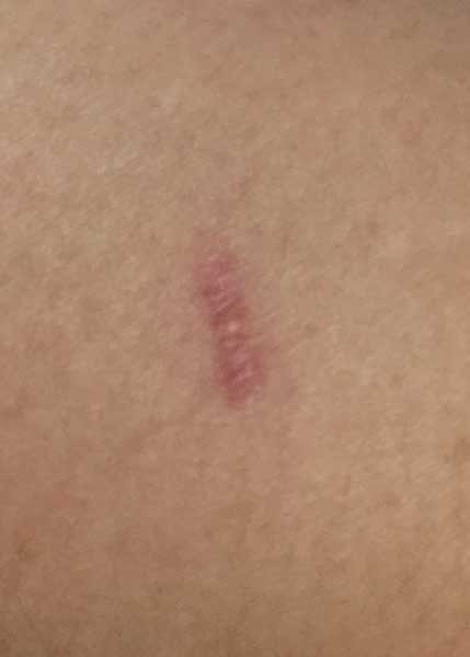 hyper-pigmented scar