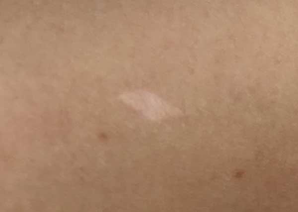 hypo-pigmented scar