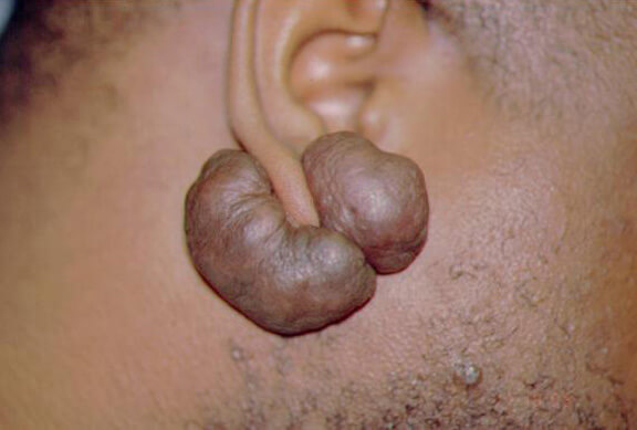 keloid resulting from an ear piercing