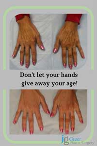 fix old looking hands with Radiuses filler