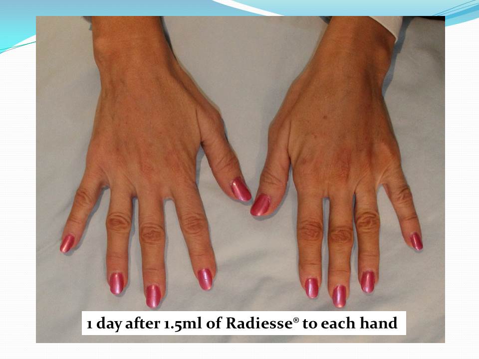 younger hands with radiesse