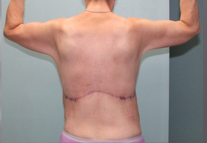 removed excess skin after weight loss
