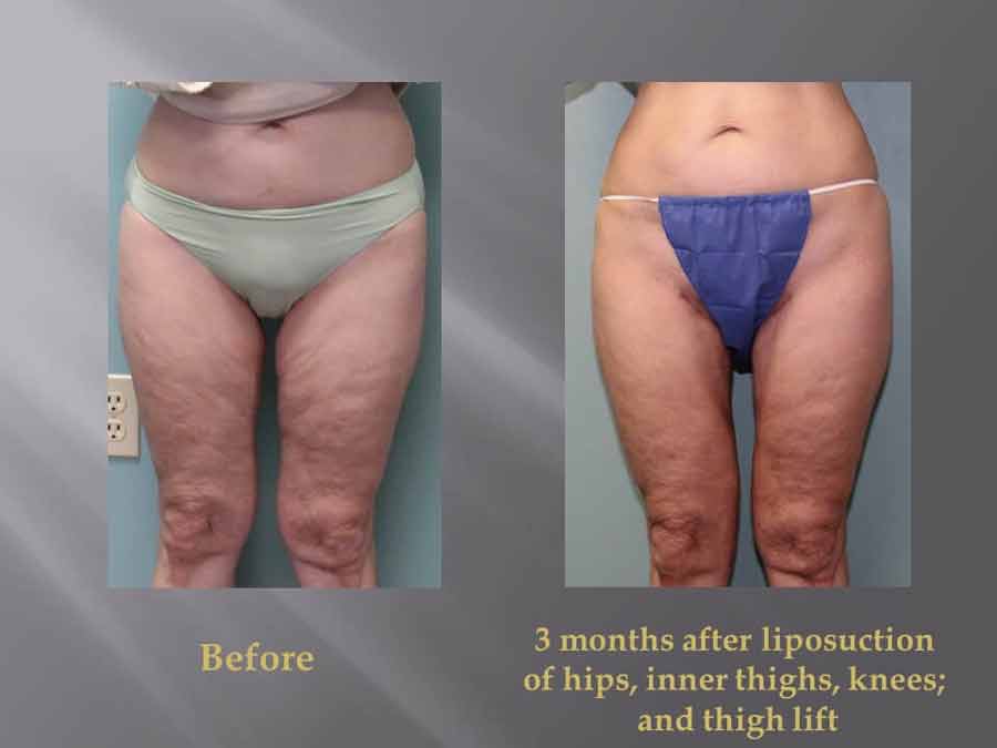 thigh lift in mentor ohio