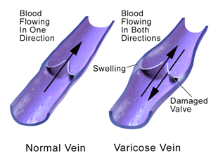 What is the Difference Between Varicose Veins and Spider Veins?