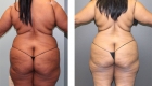 Body Liposuction in Mentor, OH