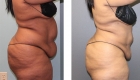 Body Liposuction in Mentor OH