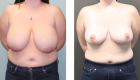Breast Reduction-11