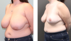 Breast Reduction-11