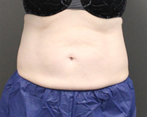 Before & After Coolsculpting in Mentor