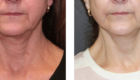 Greer Plastic Surgery Face Lift Before & After