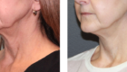 Greer Plastic Surgery Face Lift Before & After