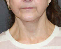 Before & After Face and Neck Lift in Mentor