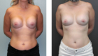 Breast Implants Removal in Mentor