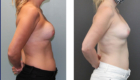Breast Implants Removal in Mentor
