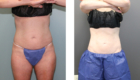 Coolsculpting in Mentor OH