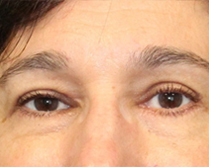 Lower Eye and Lateral Brow Lift in Mentor