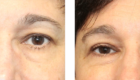 Lower Eye & Lateral Brow Lift
