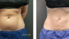 Non-invasive Abs CoolScultping in Mentor OH