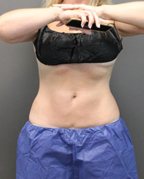 Abs Coolsculpting in Mentor OH