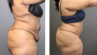 Skin Removal after Tummy Tuck in Mentor