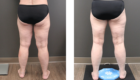 Thighs and Knees Liposuction in Mentor, OH