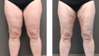 Thighs and Knees Liposuction