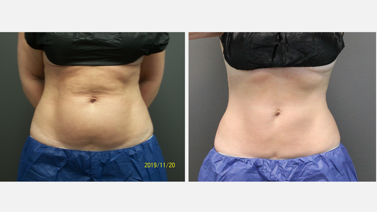 CoolSculpting Treatment in Mentor, Ohio