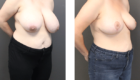 Mentor Breast Reduction Clinic