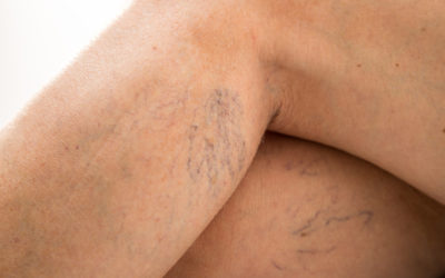 How Do I Get Rid of Spider Veins