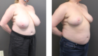 Breast Reduction-14