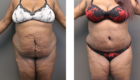 Abdominoplasty and Liposuction of the Abdomen in Mentor