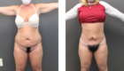Liposuction in Mentor OH