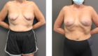 Late 50s Breast Lift and Augmentation