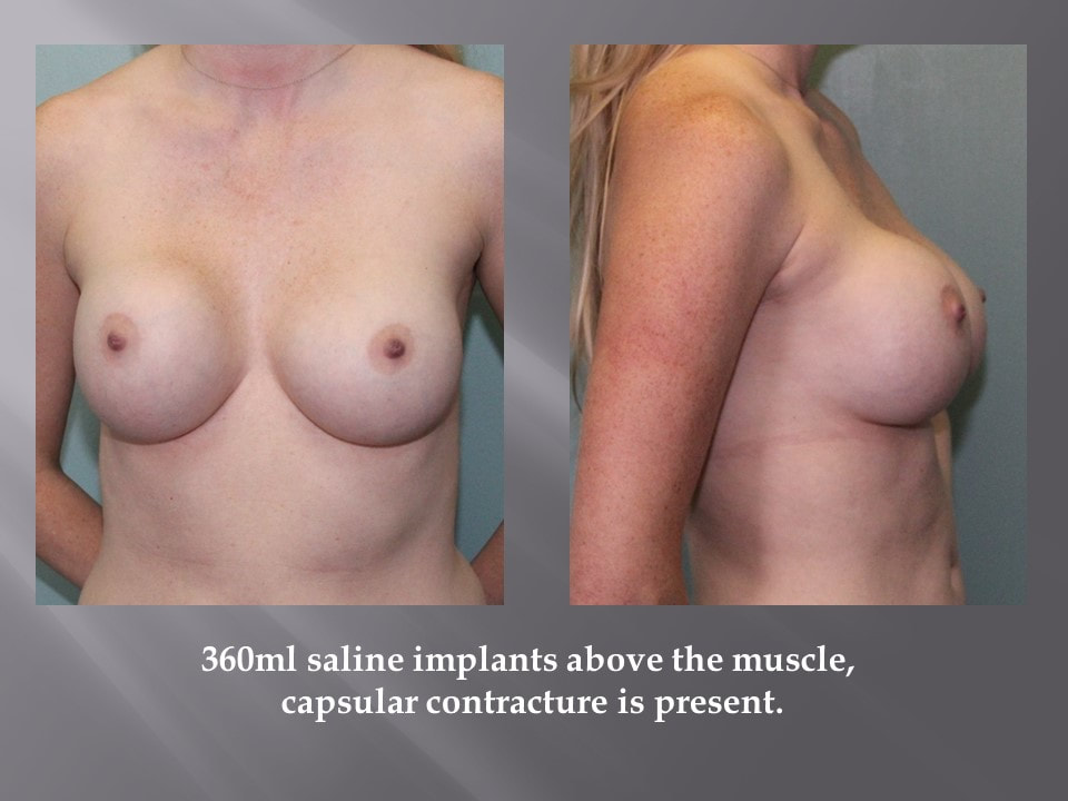 Breast Implant Removal Surgery