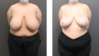 breast reduction Procedure in Mentor, OH
