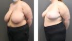 breast reduction Procedure in Mentor, OH