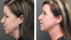 Face Lift & Neck Lift Gallery – 13