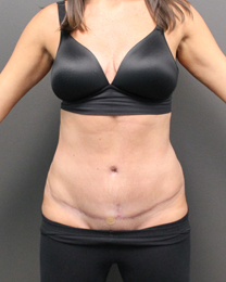 Liposuction - AB025 Postop 1 Mo Front