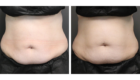 Waist Coolsculpting in Mentor OH