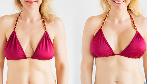 Breast Augmentation Cost: This is What to Expect