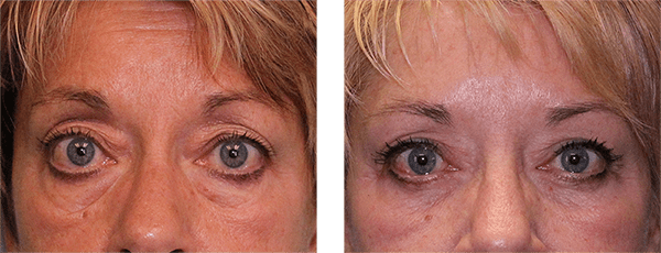 Real patient real result at Greer Plastic Surgery