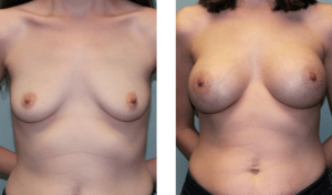 Augmentation 3 months after surgery. Late-20s. 450ml silicone implants, under the muscle.