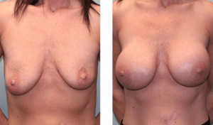 Augmentation 3 months after surgery. Early-30s. 415ml silicone implants, above the muscle.
